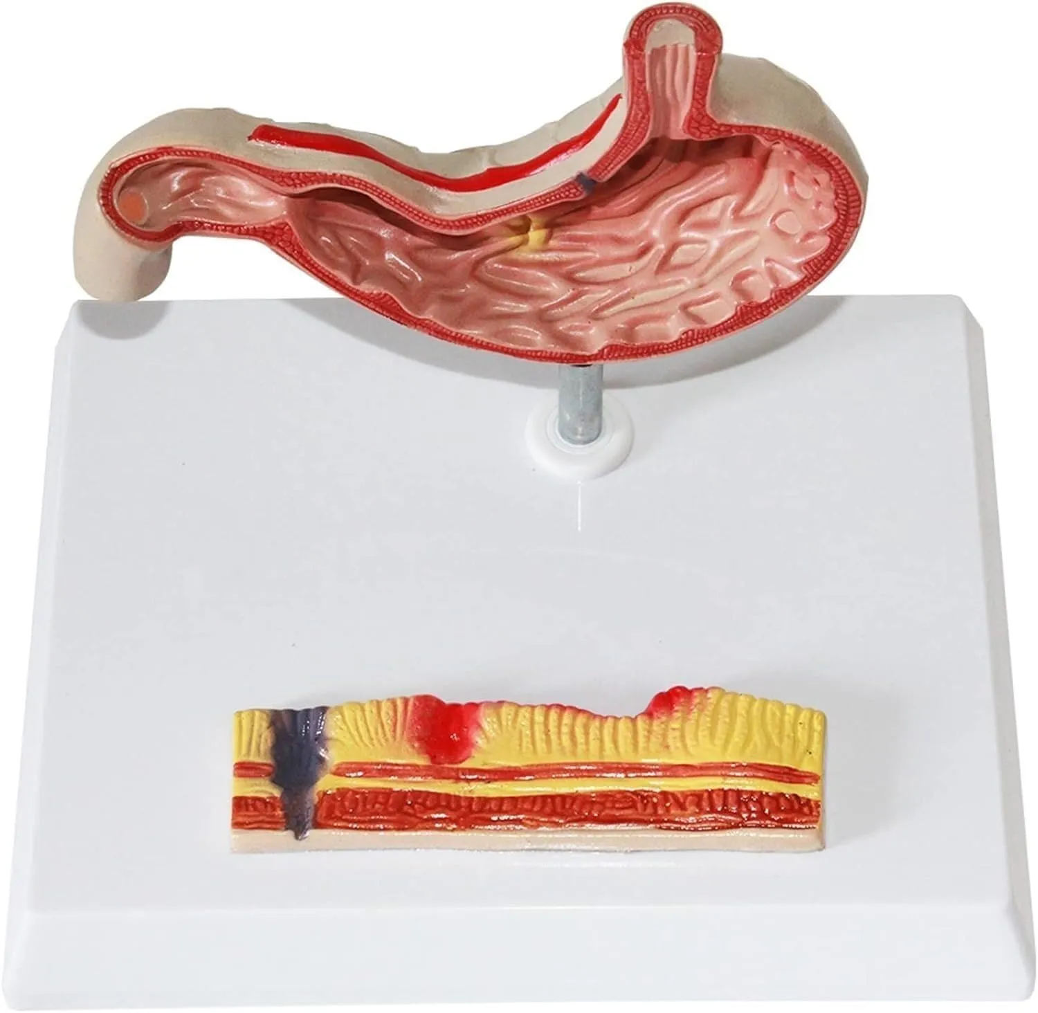 profitable woodpecker behave ablaze Learning Tool Gastric Perforation gastric Pathology Model, Human Stomach Anatomy Model, gastric Pathology Gastritis Ulcer Medical Teaching 