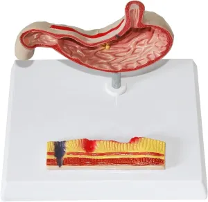 profitable woodpecker behave ablaze Learning Tool Gastric Perforation gastric Pathology Model, Human Stomach Anatomy Model, gastric Pathology Gastritis Ulcer Medical Teaching 